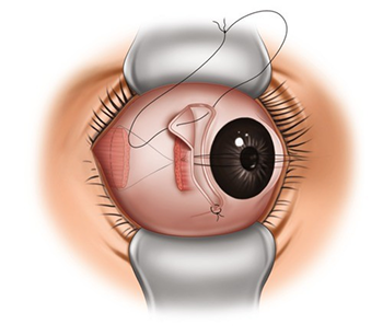 Illustration showing surgical correction of adult strabismus by adjusting eye muscles