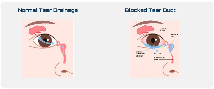 Normal and blocked tear drainage showing lacrimal sac and tear duct anatomy in lacrimal sac surgery for tear duct obstruction