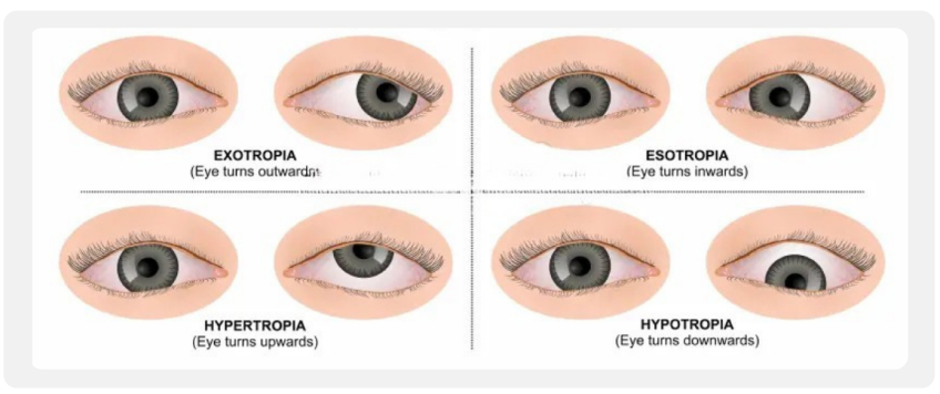 Cosmetic adult strabismus treatment in Dubai showing different types of eye misalignment in adults